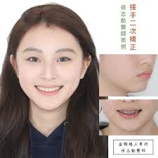 謝( 家仁牙科中心)  的口腔頜面外科專科醫生李芷瑩醫生，深入解構大家對「正頜手術」的常見誤解。原來正頜手術唔止係改變外觀，更係解決因為顎骨發育異常導致的咬合問題、發音困難、甚至影響呼吸健康等功能性問題。  ＃正頜手術＃