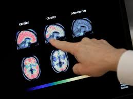 Has this phase 1 study aducanumab is the latest in a line of therapies that hope to become a treatment for alzheimer's. 65qvvkbekpd1jm