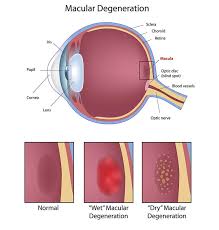 Macular Degeneration Paramus Eye Exam Paramus Metro Eye