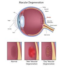 macular degeneration paramus eye exam paramus metro eye