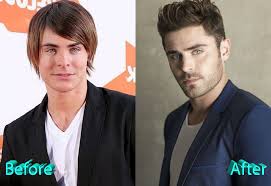 Can't find recent news on him doing surgery. Zac Efron Plastic Surgery A New Look For Teen Heartthrob
