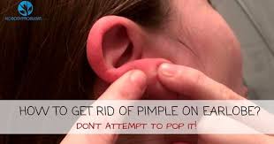 How To Get Rid Of Pimple On Earlobe Don T Attempt To Pop It No Body Problems How To Get Rid Of Pimples Pimples Body Pimples
