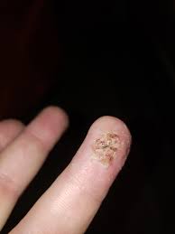 Check spelling or type a new query. Got This Bad Boy Almost Gone Soaking And Putting Compound W After Work Tonight More Updates Tomorrow Warts