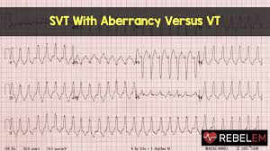 Parts of ekg waveform (image). Svt With Aberrancy Versus Vt Rebel Em Emergency Medicine Blog