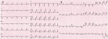 A service of the national library of medicine, national institutes of health. Evolutionary De Winter Pattern From De Winter Ecg To Stemi A Case Report Bmc Cardiovascular Disorders Full Text