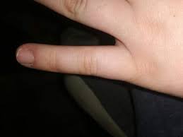 Der schmerz einer prellung ist jedoch genauso stark wie der schmerz eines bruches, so dass er als zuverlässiger indikator ausscheidet. Finger Gebrochen Oder Noch Nichr Bruch