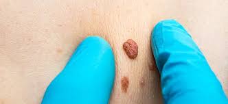 How to get rid of piles bleeding/hemorrhoid skin tag at home | bawaseer ka ilaj | anam home remedyplease support us by like and share our more videos :) disc. Anal Warts Skin Tags Los Angeles Hemorrhoid Clinic