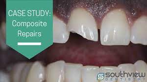 Toothaches or other dental pains are often a sign of a cavity. Case Study Composite Front Teeth Repairs Southview Dentistry