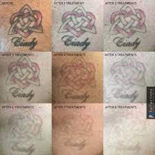 How many sessions are needed? Best Tattoo Removal Treatments Near Me Nj Laser Tattoo Removal Cost
