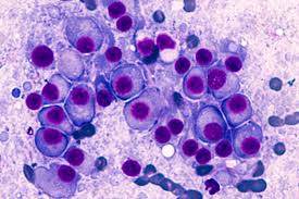 Sometimes, these types of cancer start in other types of blood cell and then spread, or metastasize. Nice Recommends New Triple Therapy Treatment For Multiple Myeloma