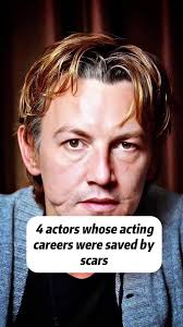 Michael Hollick Scar