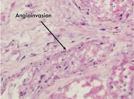 Symptoms include fever, headache, coughing, shortness of breath, abdominal pain, bloody vomit, and possible altered mental. Invasive Fungal Orbitorhinocerebral Mucormycosis Eyerounds Org Ophthalmology The University Of Iowa