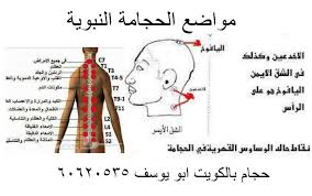 سلسلة مواضع الحجامة النبوية 1 حجامة حجام الكويت ابو يوسف ٦٠٦٢٠٥٣٥ فيسبوك