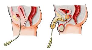 Image result for Urethral Catheterization