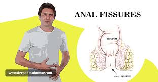 Deutsches teen wird in den arsch gefickt. Anal Fissure Treatment Vps Lakeshore Hospital Kochi Symptoms