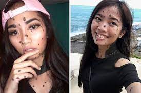 As delmundo told elle malaysia in a recent interview now, delmundo said, she's grateful she didn't change a thing. Girl Bullied As Monster For Moles Covering Body Hopes To Become Next Miss Universe Daily Star