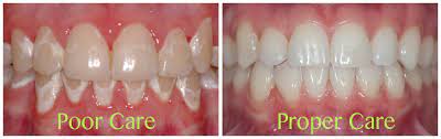 Do Orthodontic Braces Cause White Spots On Teeth Dr Kyle Fagala