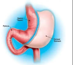 Do not drink when you eat. Laparoscopic Sleeve Gastrectomy Michigan Bariatric Surgery