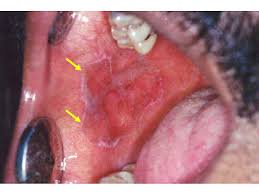 Image result for lichen planus on tongue)
