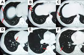 Nasopharyngeal cancer treatment options include radiation therapy, chemoradiation followed by adjuvant chemotherapy, surgery, and chemotherapy. Suspected Aerogenous Lung Metastases From Nasopharyngeal Cancer The Annals Of Thoracic Surgery