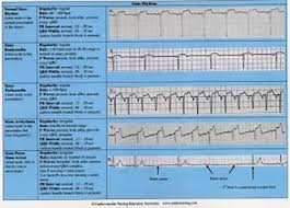 Cardiac Arrhythmias Reference Chart