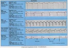 cardiac arrhythmias reference chart