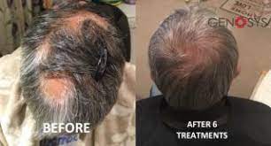 The process involves using a device called a dermaroller, which features small fine needles that make tiny puncture holes in the skin. Beauty Lodge Micro Needling For Hair Regain Health And Beauty Clinic