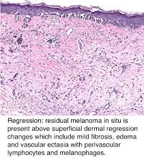 Pathology Outlines Pathologic Tnm Staging Of Melanoma Of