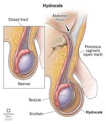 Hydrocele surgery