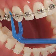 Smaller food particles can become wedged between teeth and archwires, making it difficult to maintain good oral hygiene. How To Floss With Braces Premier Orthodontics