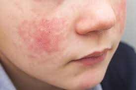 Image result for red rash face