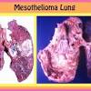 Most diagnosed cases are pleural mesothelioma, which forms on the lining of the lungs. 1