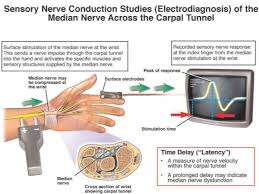 Nerve Conduction Study Nerve Conduction Study Sensory Nerves Conduction