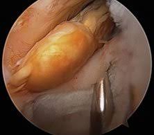 Some types of cancer can refer pain to the groin. A 24 Year Old Woman With Right Groin Pain