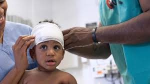 Image result for sores on the head in children
