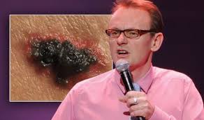Sean lock (born 22 april 1963) is an english comedian and actor. Sean Lock Health Comedian Explains Skin Cancer Symptoms And Signs Include Black Patch Express Co Uk