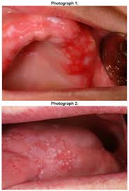 In the same general area as before, like nearby lymph nodes. Oral Cancer Awareness Of Non Consultant Hospital Doctors In Irish Hospitals Irish Medical Journal