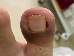 Image result for Paronychia feet