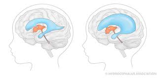 Image result for Hydrocephalus