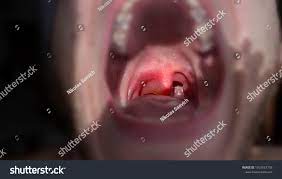 Sore Throat Allergic Reaction Angioedema Stock Photo Edit Now 1053933758