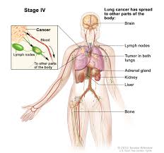 I know my cancer is terminal and survival rate is low. Non Small Cell Lung Cancer Treatment Mhealth Org