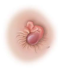 Image result for Hemorrhoid