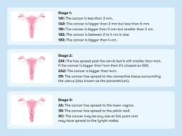 Image result for Cervical Cancer
