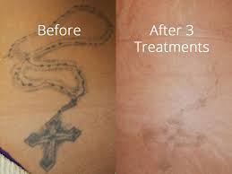 Does your permanent makeup look less attractive than you imagined? Laser Tattoo Removal Salmon Creek Plastic Surgery