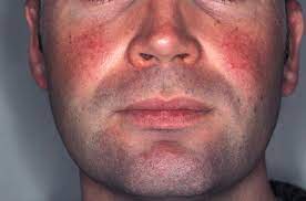 For years, people have believed that coffee. Drinking Coffee Could Be Key To Curing Rosacea Experts Discover