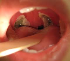 In college i was told by someone at the student health service that there was a time it was standard for children to get their tonsils out; Tonsillectomy Wikipedia