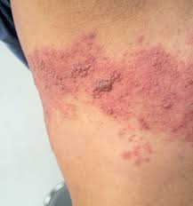 Image result for herpes zoster