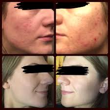 About 20,270 results (0.08 seconds). B A 6 Months Of Progress Skincareaddiction