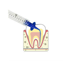 Image result for zubní kanyla