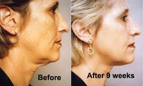As you get older, the skin on your neck gets looser. How To Get Rid Of Neck Wrinkles A Turkey Neck And A Double Chin With Exercises And Without Surgery Get A Young Turkey Neck Exercises Face Exercises Face Yoga